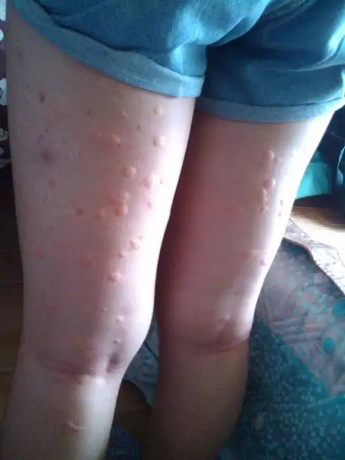 今天去菜园,结果被虫子咬了满腿的包,真的是满腿红肿发热痒,然后马上