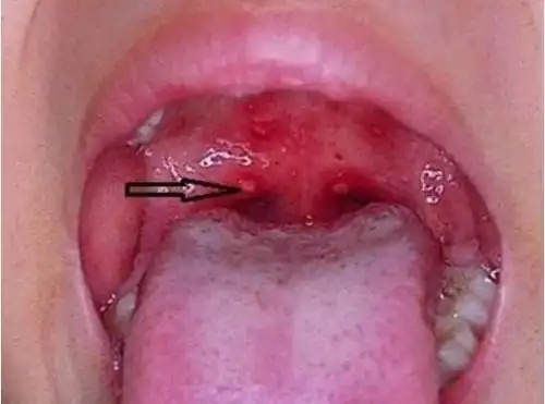 王老吉凉茶颗粒警惕小儿疱疹性咽峡炎来袭