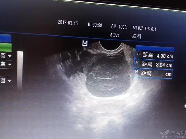 左附件区囊性包块,大家帮看看是巧克力囊肿吗?