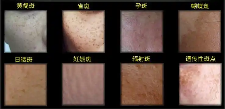 哈尔滨大美整形激光祛斑-哈尔滨大美医疗美容医院-无忧爱美网整形医院