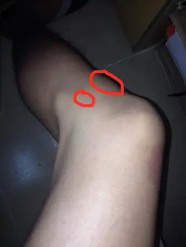 练柔道的时候被人从侧面压了一下腿(如图所示)现在膝盖外侧2个地方有