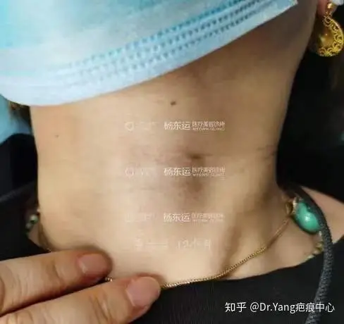 一例颈部凹陷疤痕修复案例