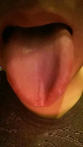 以前老舌苔白,舌侧有很长白线,其它正常.有白线是毛状白斑吗?