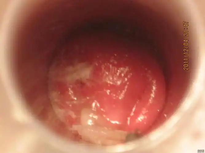 第十八例静脉曲张混合痔术前术后逐渐愈合17张图