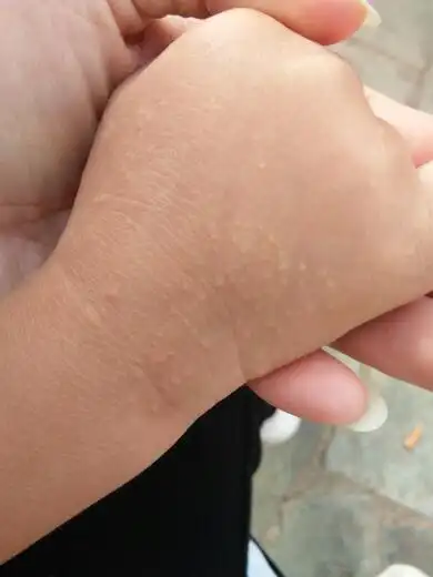 宝宝3岁手背上突然张了很多小包