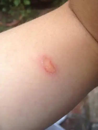 昨天晚上被烟头烫伤了,手摸了下,皮就掉了.