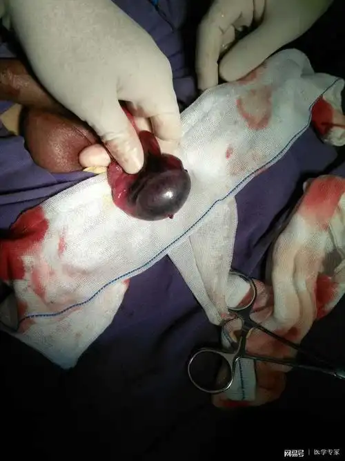 同时,要对对侧的睾丸进行固定,以防止切除单侧搞完后双侧失去平衡而