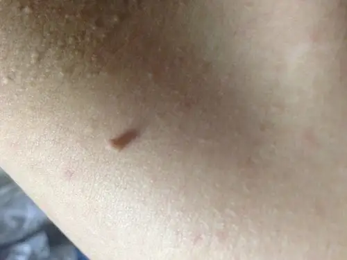 皮肤病:肩膀上方,颈下长了一个类似米粒似的东西,请懂这方面的专家给