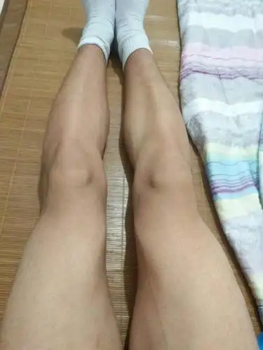 o型腿啊怎么办啊.要当兵啊