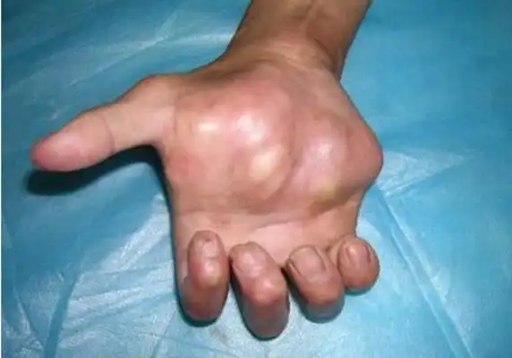 皮肤囊肿图片 (30)_有来医生