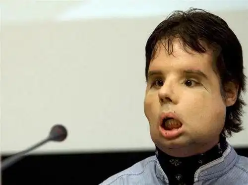 福建毁容少女将换脸 跨入禁区的变脸术(4)