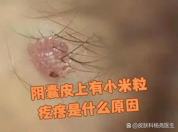 阴囊皮上有小米粒疙瘩是什么原因