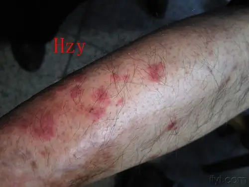 两下肢皮损一个月公布答案变应性血管炎