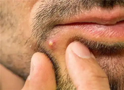 挤痘是个技术活,哪些痘痘千万不能挤?