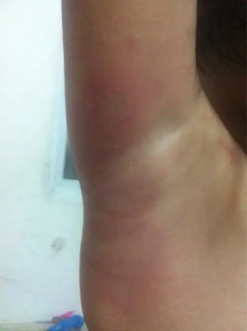 宝宝腋窝下一片红 还有白色的一小片 一碰就疼 睡觉都喊疼 不知道怎么