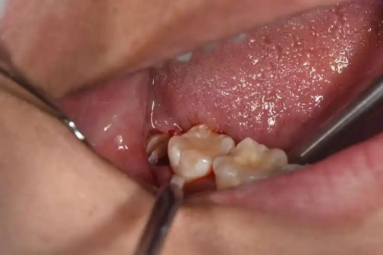 下颌智齿拔除一例