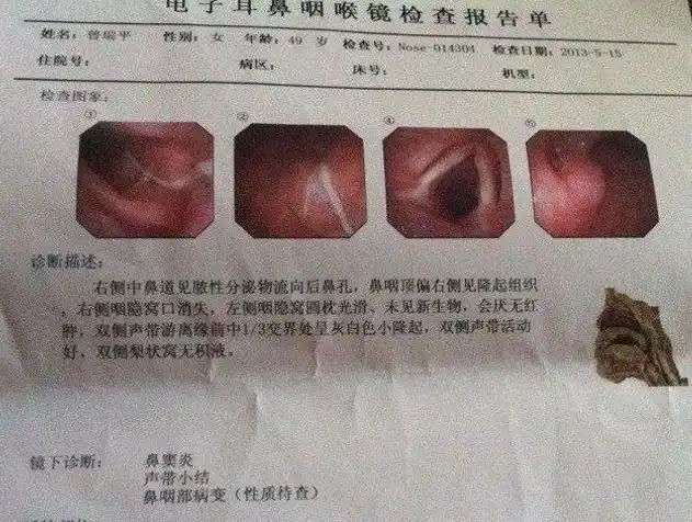 鼻咽癌能活多久做4件事养好身体多活几年不成问题