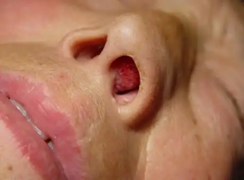 鼻甲肥大身体受个3大伤害用5物泡水喝能缓解