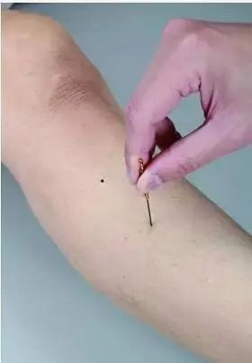 三叉一穴(十)偷针眼:灵骨(交刺)(十一)眼跳:1,针侧三里,侧下三里,肾关