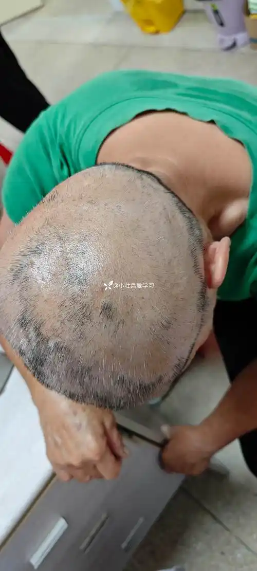 不明原因出现虫蚀状脱发,考虑?