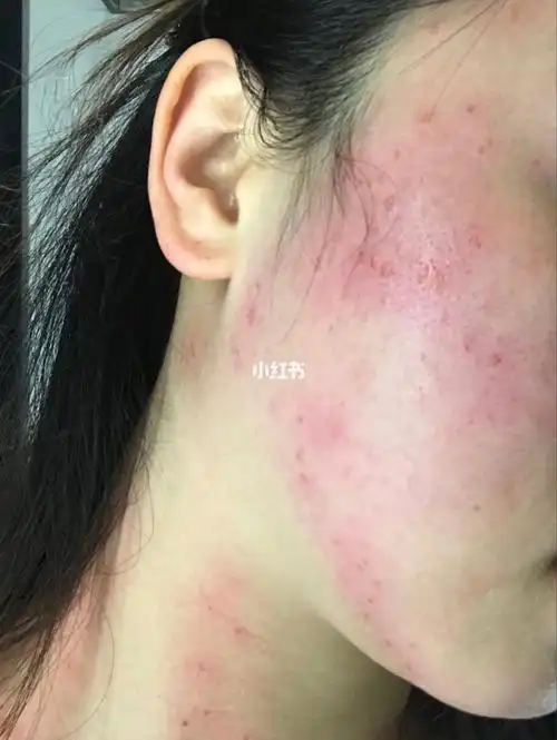 扁平疣治疗过程