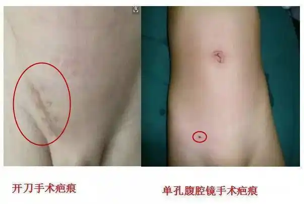 家有男宝宝,孩子出现这个症状别大意|手术|阴囊|腹股沟|斜疝|腹腔