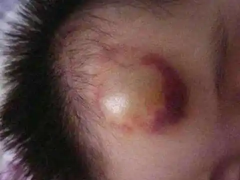 孩子头部摔伤怎么办这位妈妈的做法让医生都要为她点赞