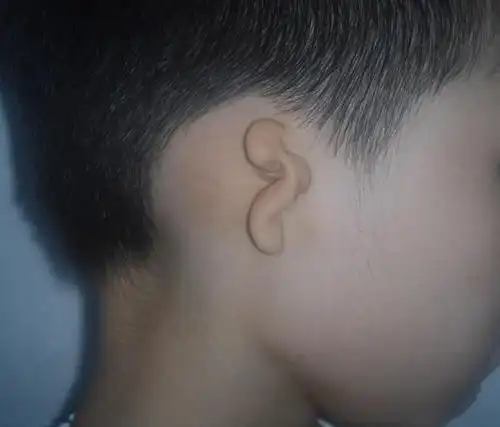 先天性小耳畸形