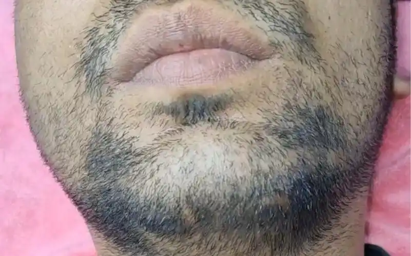 《解压实验室》:狠人拔毛系列-看印度小哥 蜜蜡拔胡子,拔胡须,拔络腮