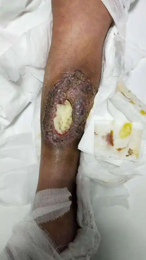 慢性骨髓炎两个月,骨缺损,美容科用骨水泥填充错误!