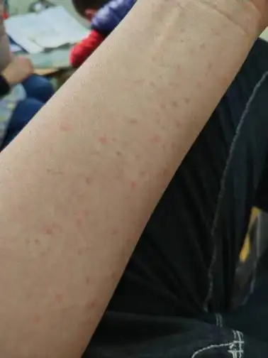 天针,还没有好,现在在吃中药,请问应该怎么治疗,现在每天都会起小红点