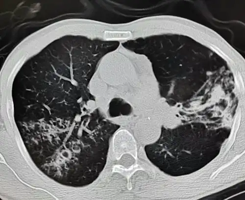 ct显示肺部支气管扩张伴感染
