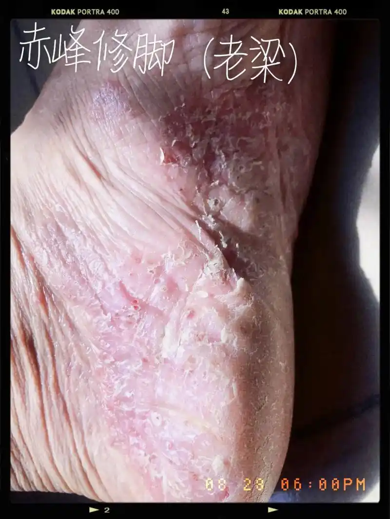 足癣和湿疹是真菌混合感染的一种常见的皮肤性顽疾#赤峰梁氏修脚 - 抖