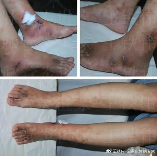 结节性血管炎双下肢红斑伴有皮肤破溃反复发病激素治疗可行吗