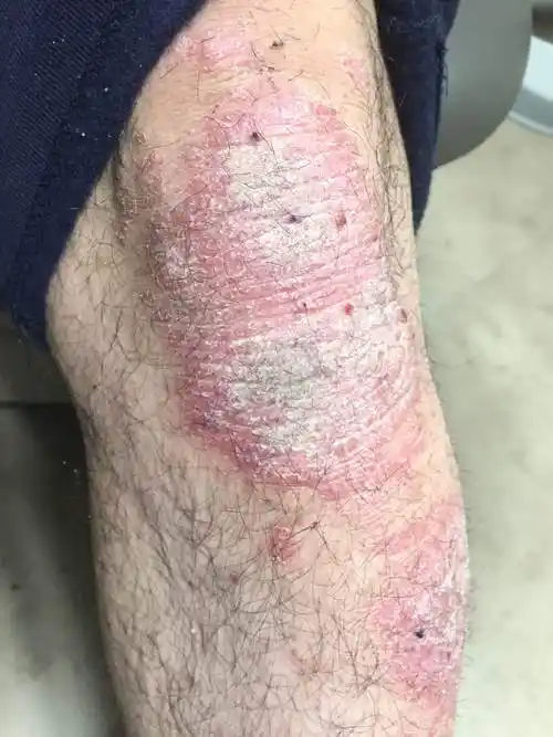 [刘医师专栏] 干癣的须知与治疗 (下)