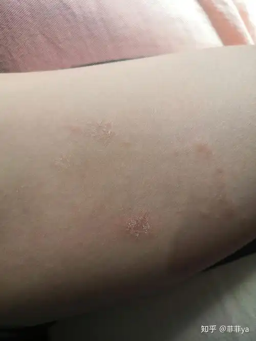 长了很多圆形的癣不痒有些起皮开始是个很小的圆慢慢扩大是什么皮肤病
