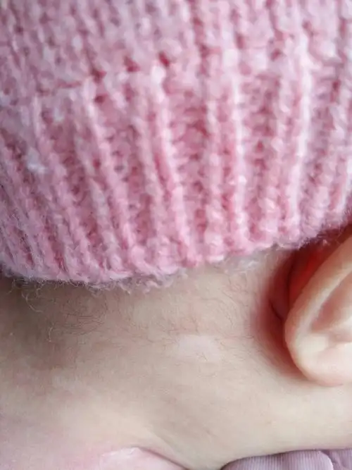 你是否曾经在自己的肌肤上发现一块白色的斑块?