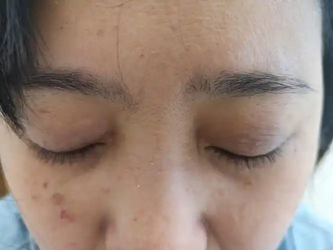 上眼皮神经性皮炎图片(眼睑红肿瘙痒) - 赤虎壹号