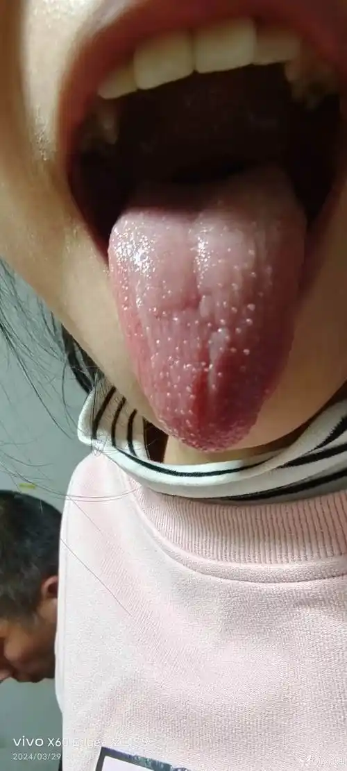 请大家看看这是什么患儿女10岁发现舌头上小疱疹1周不痛无发热头痛