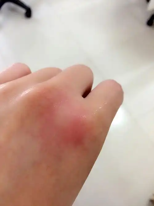 夏天到了 很容易被蚊子咬 有什么方法让蚊子不咬我吗 被咬好烦呐