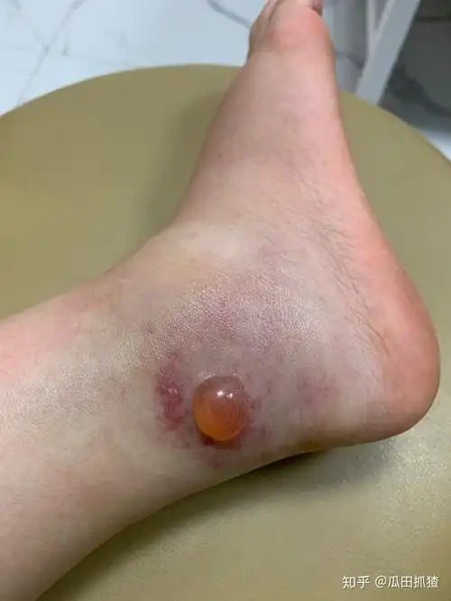 被隐翅虫咬了会怎么样? - 知乎