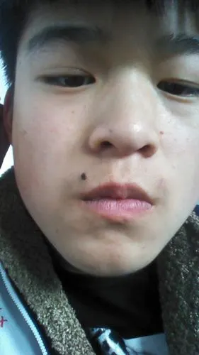 请问痦子留下的坑用什么药物才能完全长好