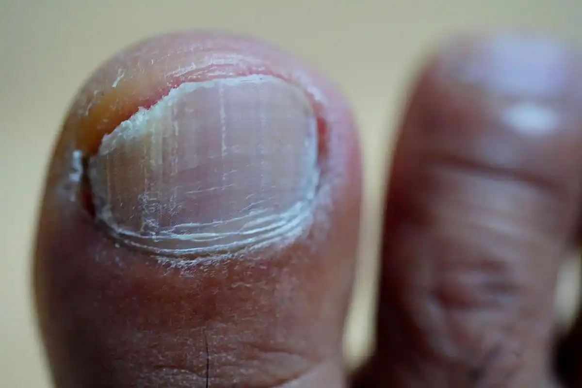 很多女孩子,由于穿高跟鞋或者是其他原因,导致了双脚大拇指指甲总是会