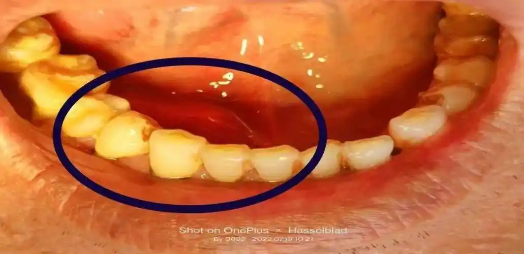 齐医附属一院口腔二科门诊成功探取国内罕见巨大颌下腺导管结石1例及