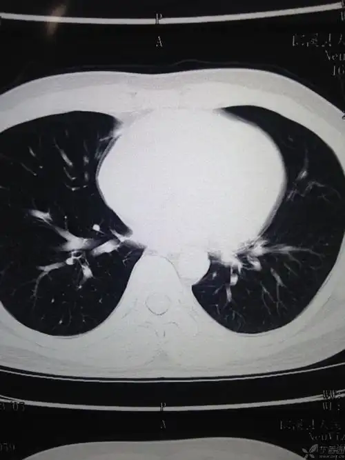 【影像读片】这样的肺部阴影能考虑什么?