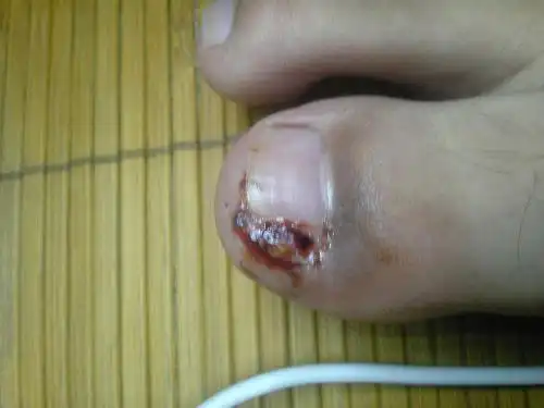 【急】甲沟炎息肉怎么治