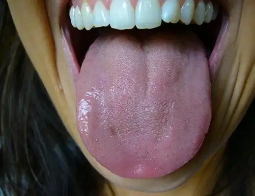 舌炎的症状图片 (35)