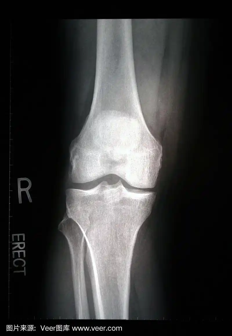 男性右膝x光片-正面直立