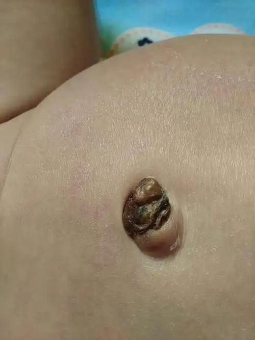 宝宝肚脐这样正常吗