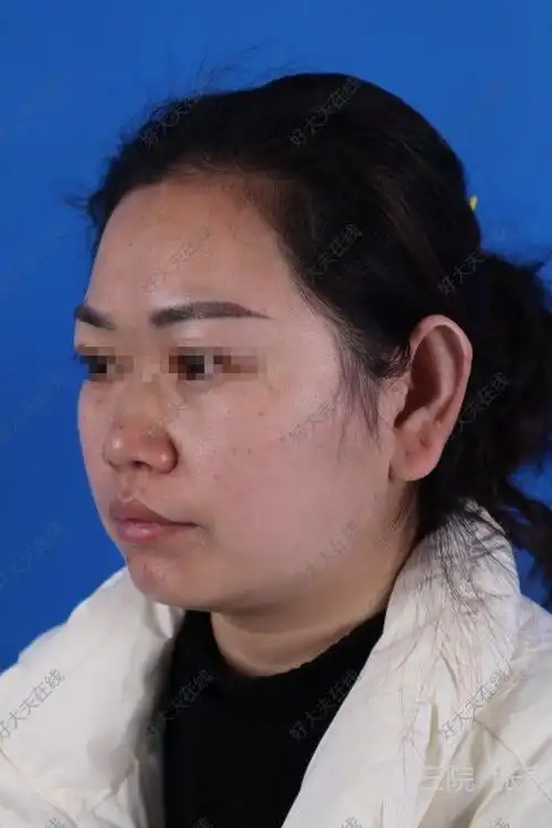 耳垂肥大_耳部整形 - 好大夫在线